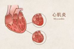 心肌炎严重吗,揭秘其严重程度与影响